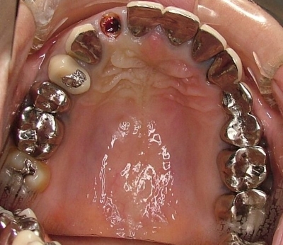 金属だらけの口腔内